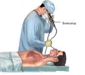 bronoskop